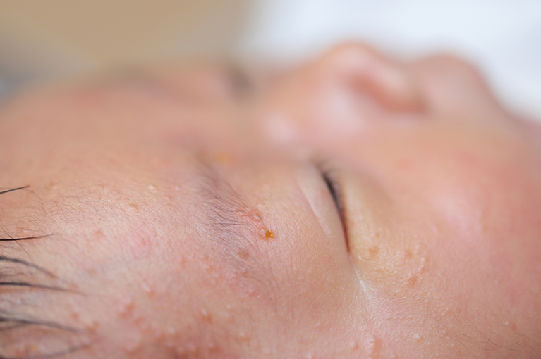 子どもの湿疹・乳児湿疹について