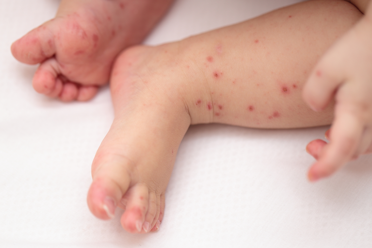 子どもの赤い発疹が出ているけど熱なし・かゆみなしで考えられる原因